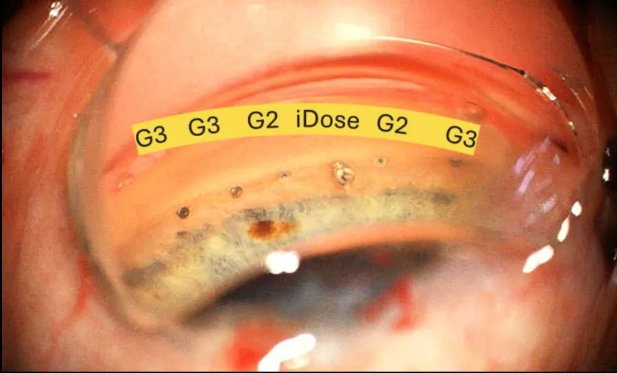 Gonioscopic view of iDose and iStent infinite implants in the drainage angle