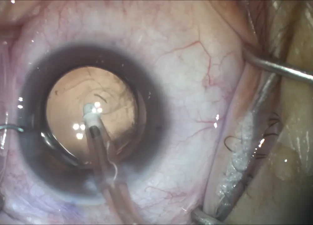 New lens implant being positioned